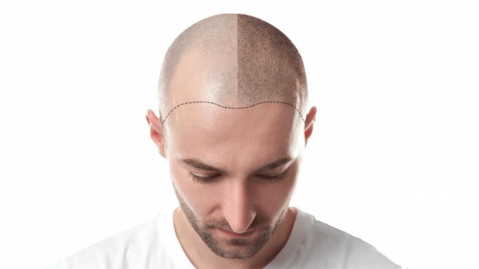 Innovative - Natural Looking Scalp Tattoo